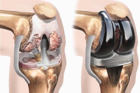اگر نیازمند جراحی استخوان یا مفصل هستید، دست نگه دارید!