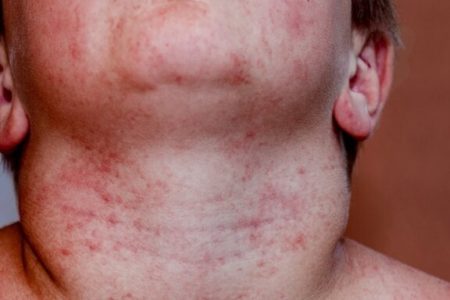 همه چیز درباره «میلیاریا روبرا»