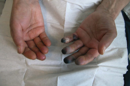 توصیه های مهم درباره سرمازدگی