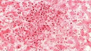 تبی که خونریزی با خودش دارد