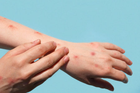 آیا واکسیناسیون از ابتلا به آبله میمون پیشگیری می‌کند؟