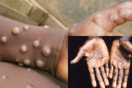 چگونه در سفر از ابتلا به آبله میمون پیشگیری کنیم؟