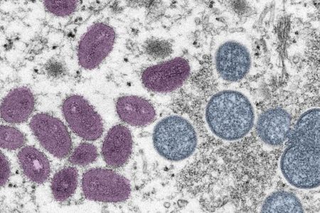 وزارت بهداشت ژاپن: موردی از ابتلا به آبله میمونی نداریم