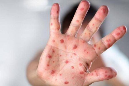 شباهت علائم آبله میمونی و آبله مرغان / نحوه نمونه گیری از افراد مشکوک به بیماری