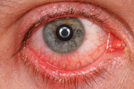 هشدارهای یک چشم‌پزشک درباره استفاده از لنزهای زیبایی و کاشت مژه