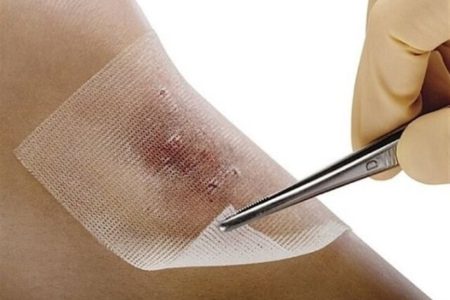 همه چیز درباره بیماری “سیاه زخم”